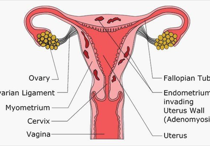 Adenomyosis: Symptoms, Diagnosis, Treatments