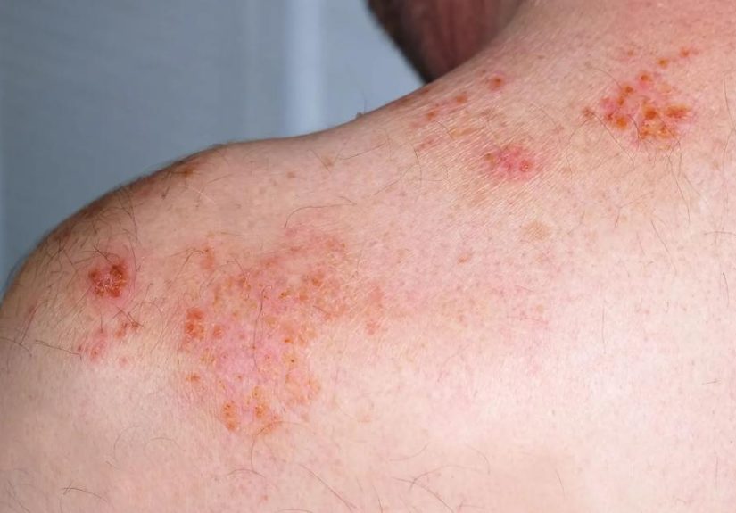 Can You Get Shingles More Than Once?