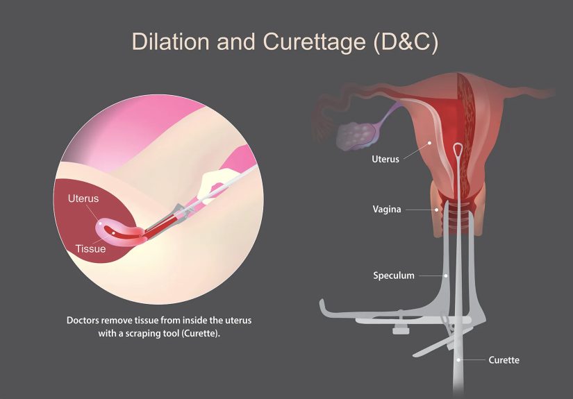 D&C (Dilation and Curettage) Procedure: Surgery and Recovery