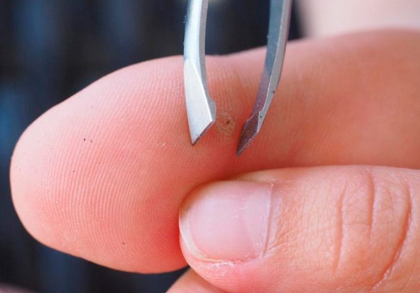 Home Remedies to Remove a Splinter