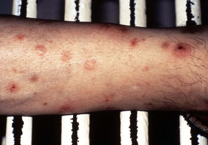 Leukemia: Symptoms, Causes, Types, Diagnosis, Treatment