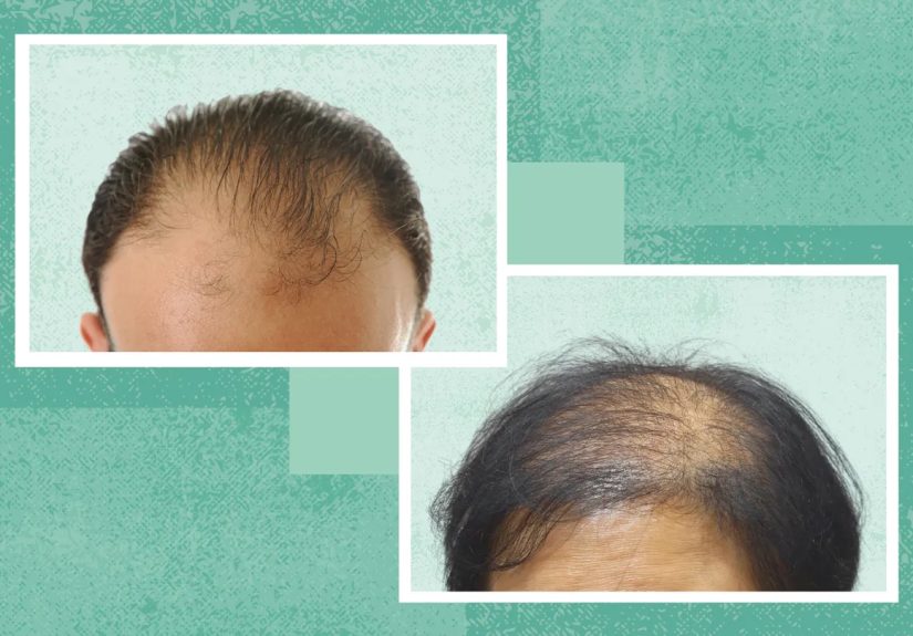 Male vs. Female Pattern Baldness (Androgenetic Alopecia): What’s the Difference?