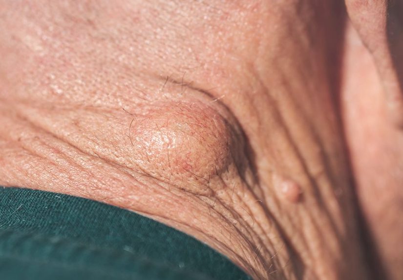 Medicare Coverage for Lipoma Removal