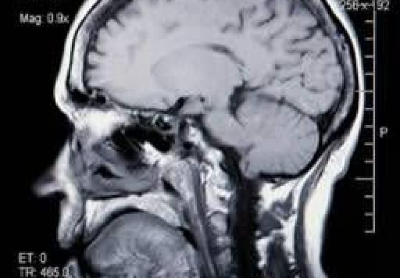 Middle-School Girls Continue Playing Soccer with Concussion Symptoms