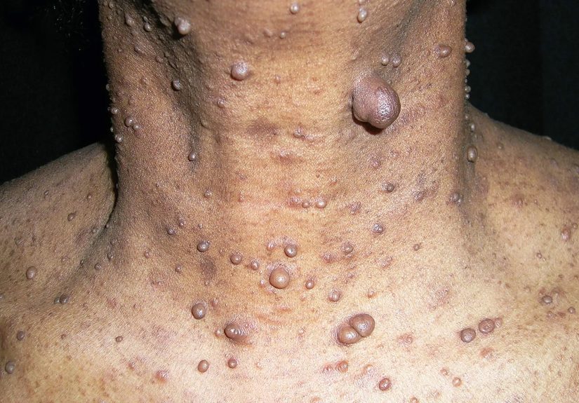 Neurofibromatosis: Types, Symptoms, Causes, and Treatments