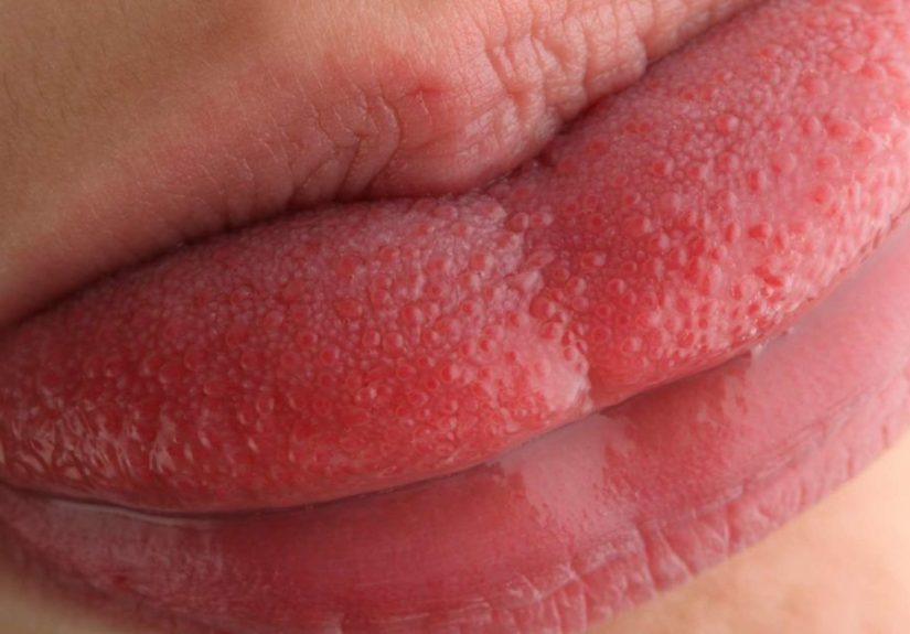Swollen taste buds: Causes, diagnosis, and treatment
