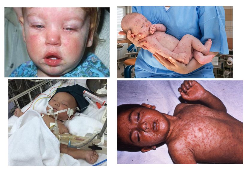 The measles outbreak, media imagery, and the thoughtful focus of fear