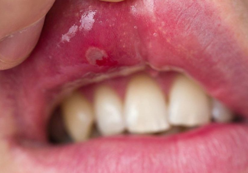 Úlceras bucales: Tipos, causas, síntomas y tratamiento