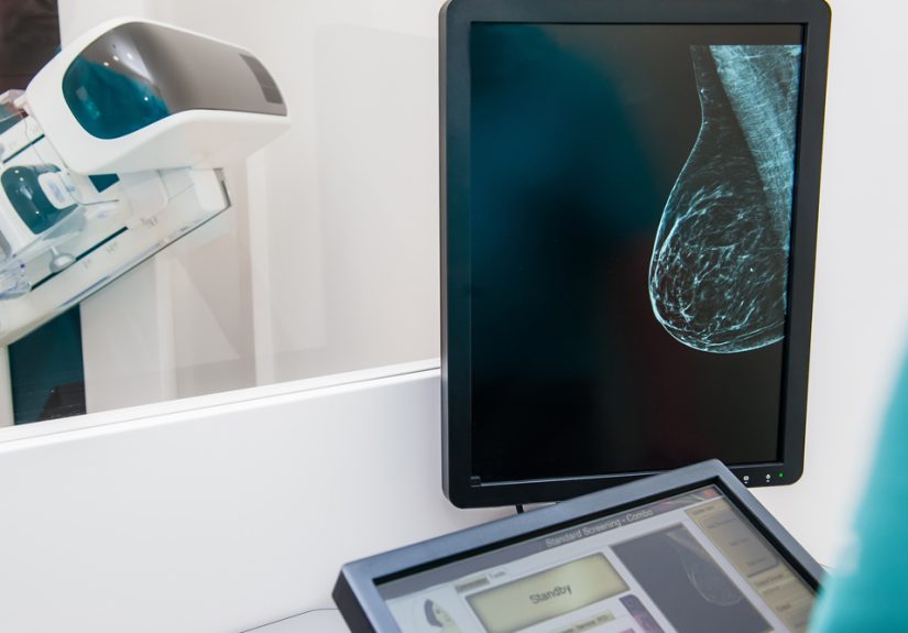 When Breast Cancer Screening Guidelines Conflict: Some Patients Face Real Consequences