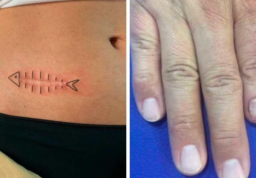 50 Times People Asked Tattoo Artists To Cover Up Their Scars And Birthmarks And Couldn’t Be Happier With The Result