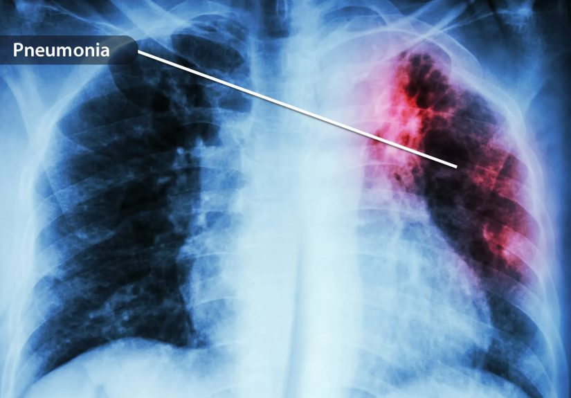 Coronavirus: What Happens To People's Body If They Get Infected