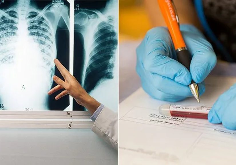 How Tuberculosis Is Diagnosed: Screenings and Tests