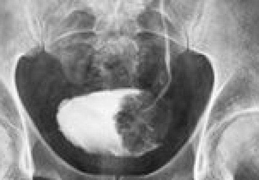 Overactive Bladder Diagnosis: What Tests to Expect