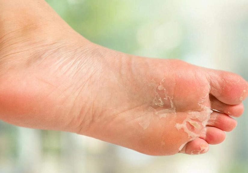 Peeling Feet and Toes: Causes and How To Fix It