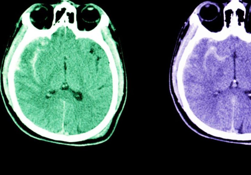 Subarachnoid hemorrhage: Symptoms, causes, and diagnosis