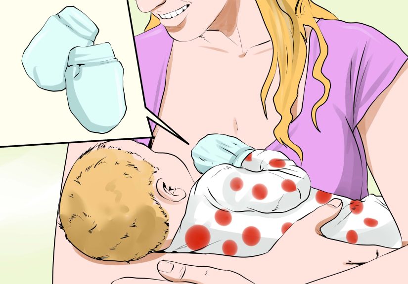 3 Ways to Treat Chicken Pox Scars