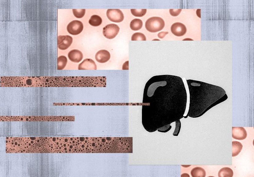 Anemia and cirrhosis: Possible links and more