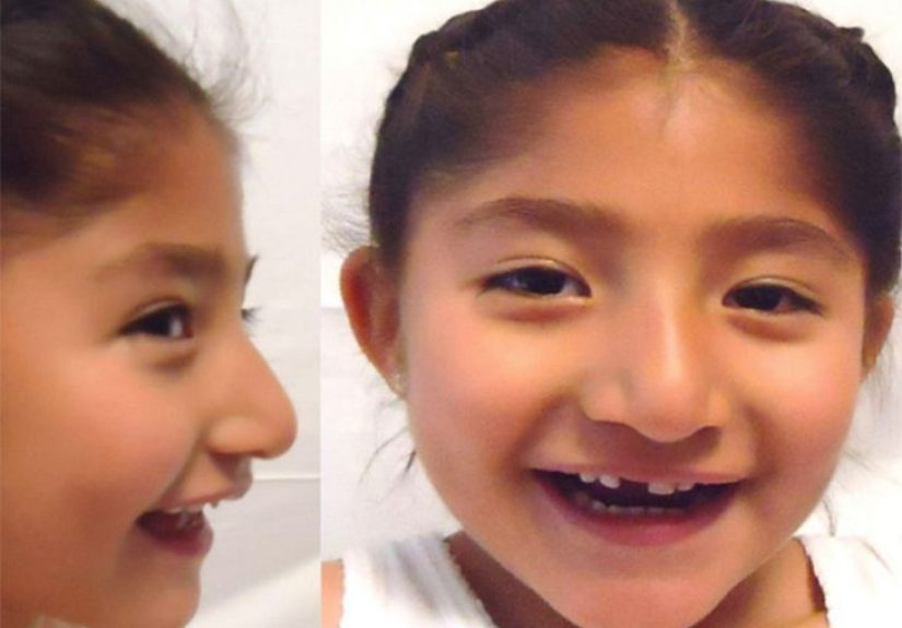 Angelman syndrome (AS): Definition, causes, and treatments