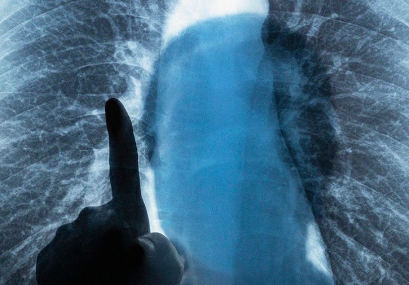 COPD and lung transplants: Benefits, eligibility, and life expectancy