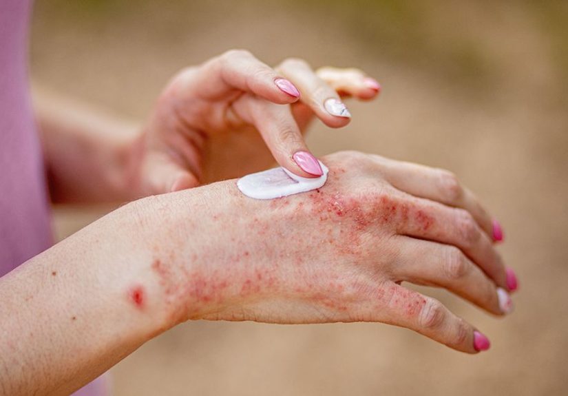 Generalized Pustular Psoriasis (GPP) Treatment