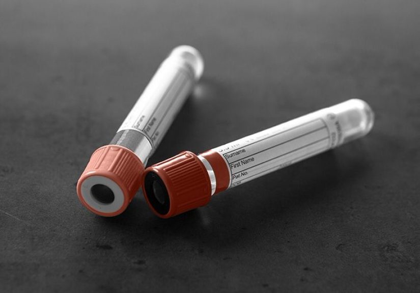 Hemophilia A vs. B: What to Know