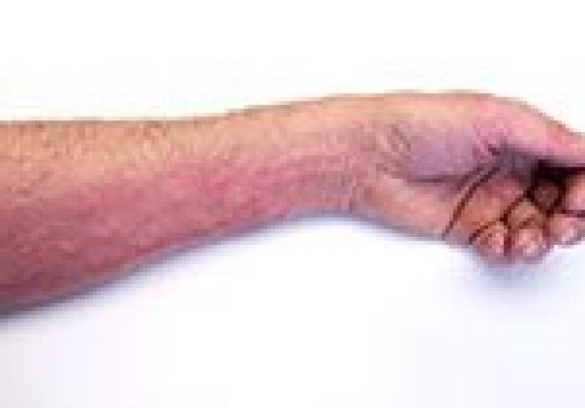 Severe Allergy: Symptoms and Treatment