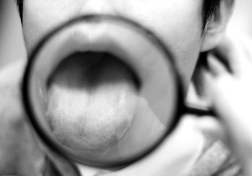 Sore on the side of the tongue: Symptoms, causes, and more
