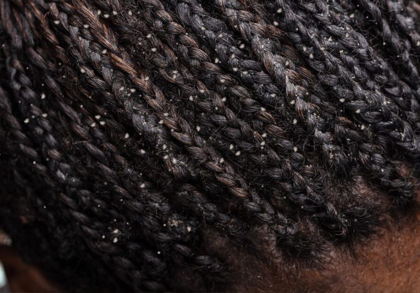 Types of Dandruff: Causes, Treatment, Prevention