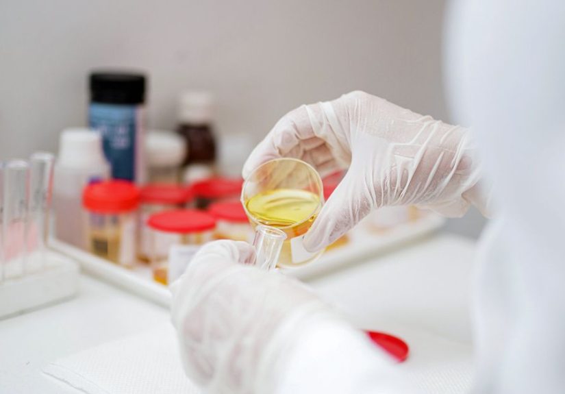 Bilirubin in Urine (Bilirubinuria): Symptoms, Causes, Treatment