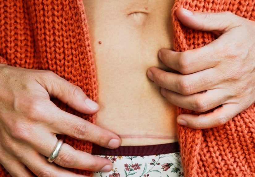 C-Section Scars: Types of Incisions, Healing, and Minimizing Scars