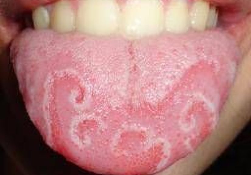 Geographic Tongue: Causes, Pictures, and Treatment