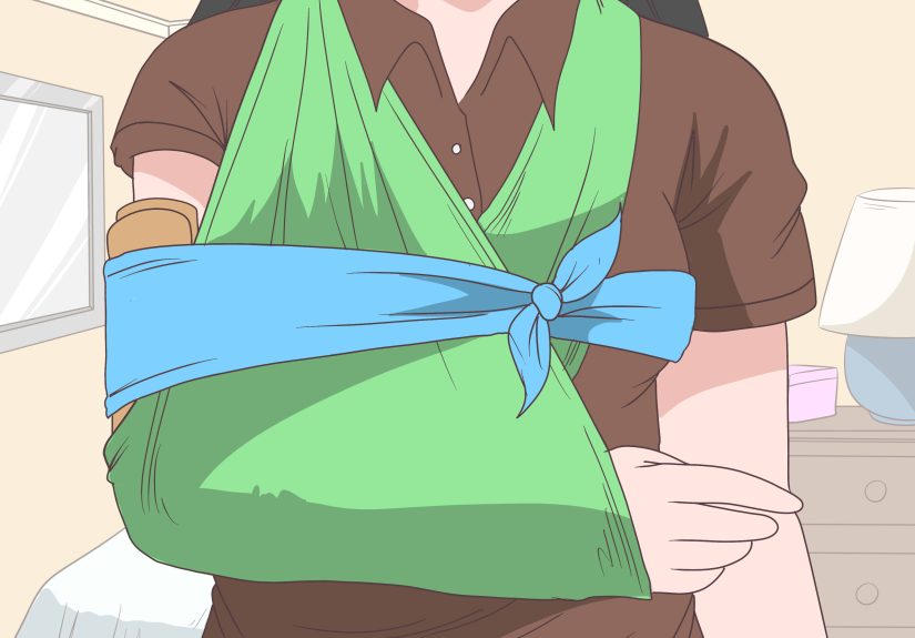 How to Splint a Humerus Fracture: 8 Steps