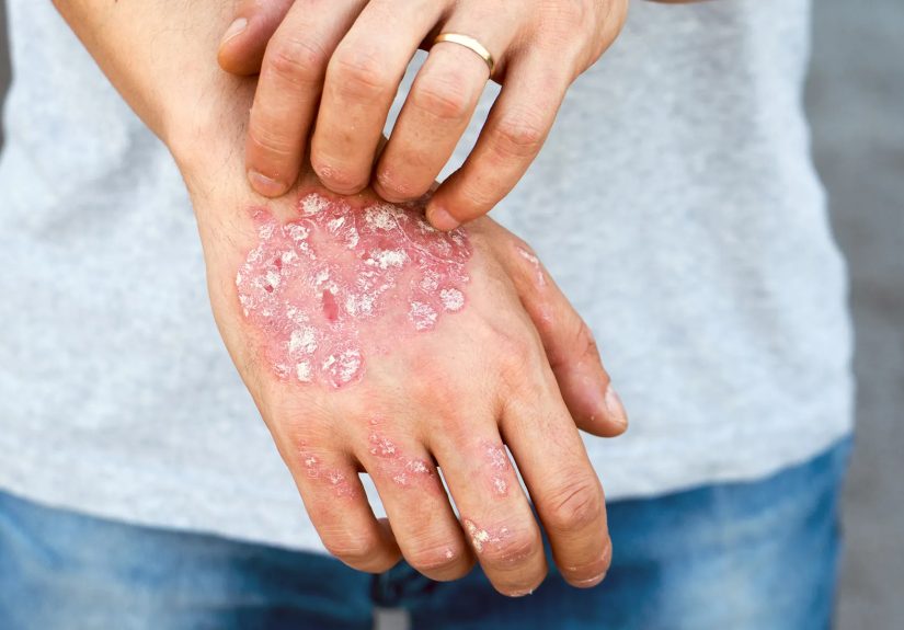 Pictures of Tips for Managing Psoriasis on Your Hands