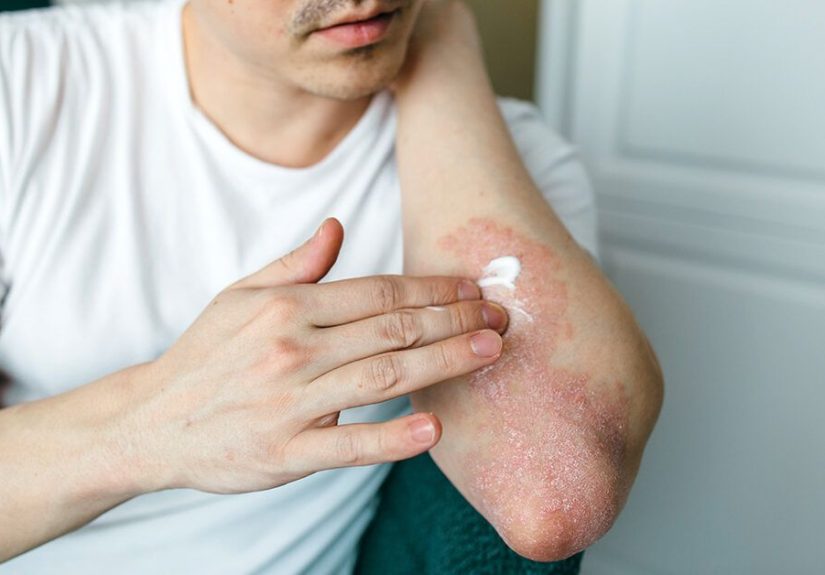 Plaque Psoriasis Treatment Options, Benefits, and Risks