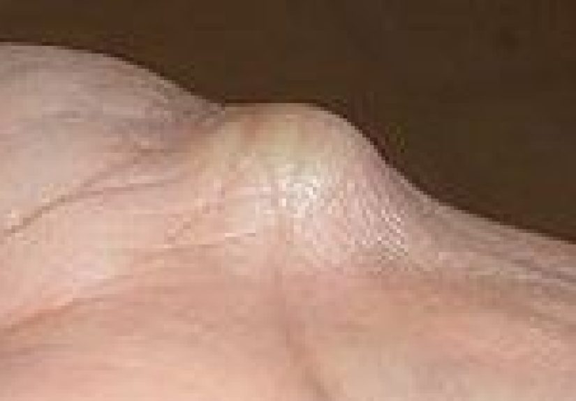 Quistes: Imágenes, causas, tipos, tratamientos y prevención