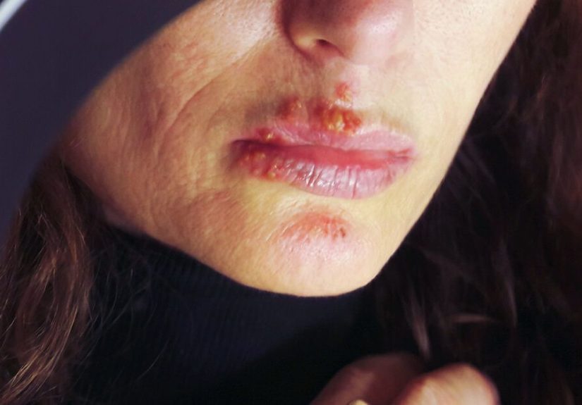 Recurrent Herpes Simplex Labialis