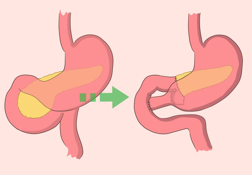 4 Easy Ways to Keep Your Pancreas Healthy