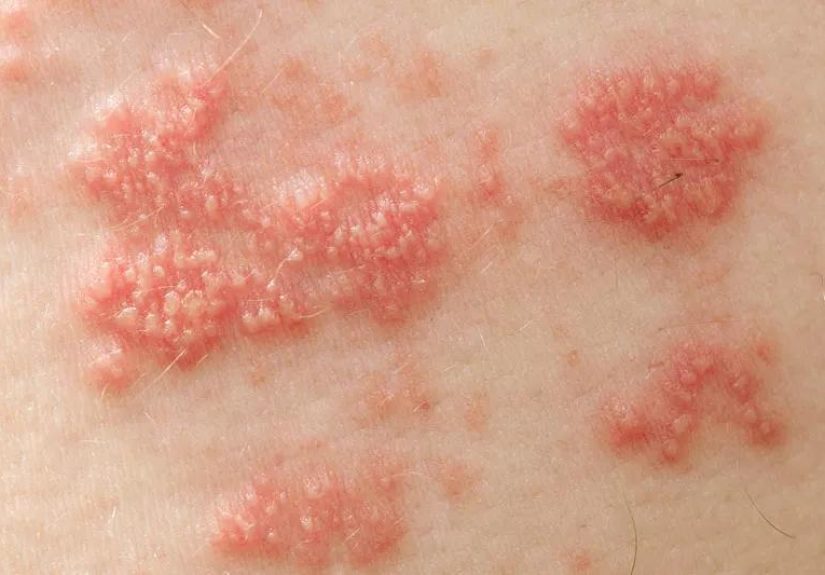 5 Options to Relieve Pain After Shingles