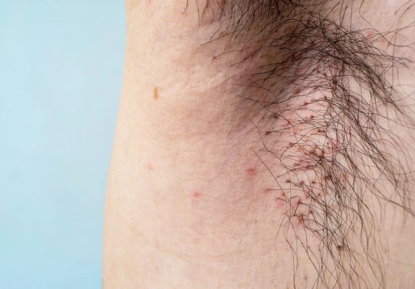 Body Lice: How to Recognize an Infestation Early  and Stop It Quickly