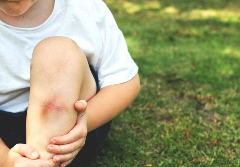 Bruised Muscle (Muscle Contusion): Symptoms and Treatment