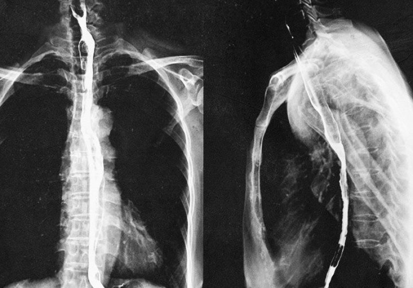 GERD and asthma: Link, symptoms, treatment, and more