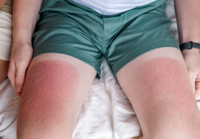 Home Remedies for Sunburn: Cool Water, Aloe Vera, and More
