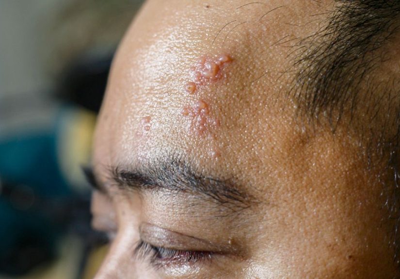 Shingles in Young Adults: Why It’s Possible, Symptoms, and More