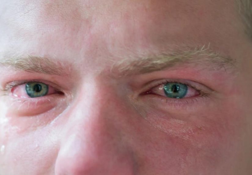 Ways To Get Rid of Swollen Eyes From Crying