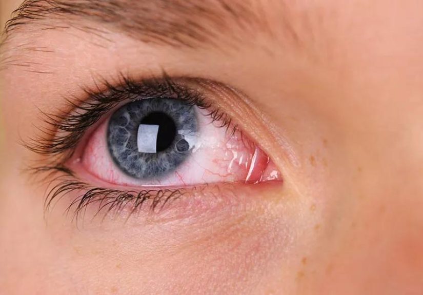 Why Are My Eyes Always Red?